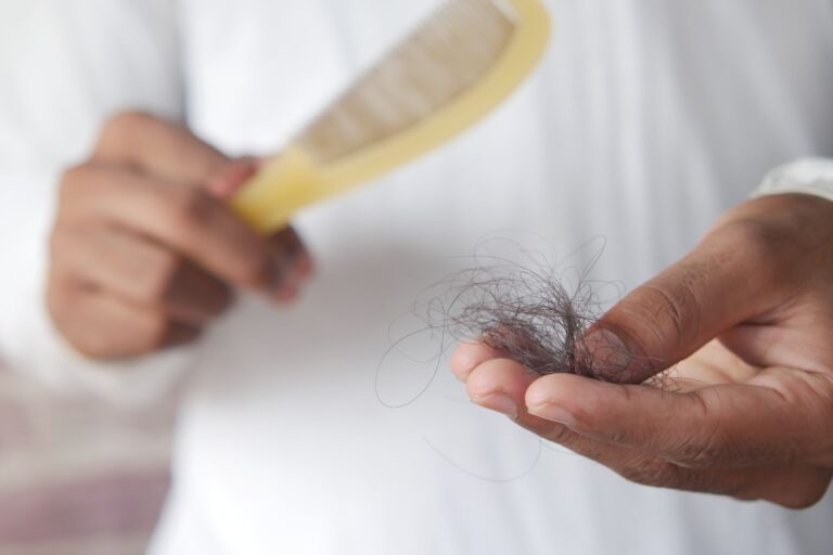 Alopecia fibrosante frontal: causas, síntomas y tratamientos efectivos