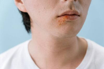  Candidiasis oral: síntomas y prevención de Candida albicans boca