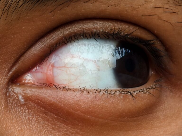 Derrame en el ojo: ¿Qué es, causas y qué hacer?