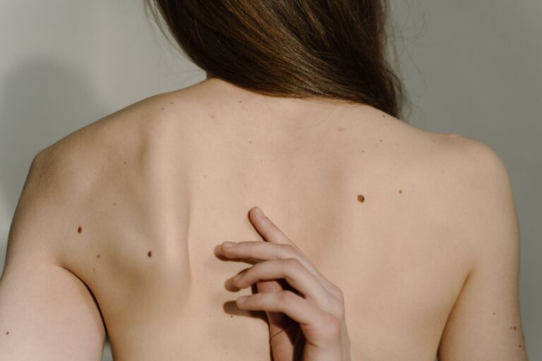Fibromas en la piel: causas, tratamiento y cuidados esenciales