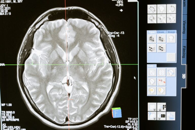 Holocraneal significado: Tipos de cefaleas y sus causas