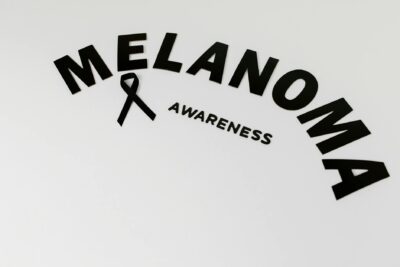  Lunares benignos: Importancia y prevención del melanoma