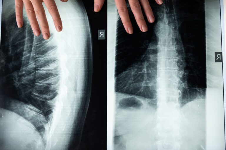 Punción lumbar riesgos: Todo lo que necesitas saber hoy
